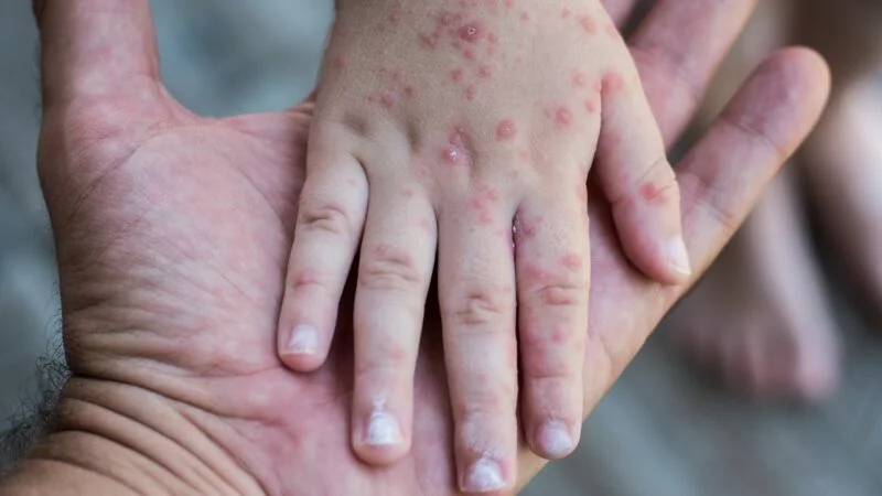 Difunde SET medidas sobre el virus boca-mano-pie entre la comunidad educativa